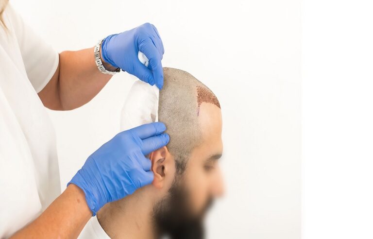 Hair transplant