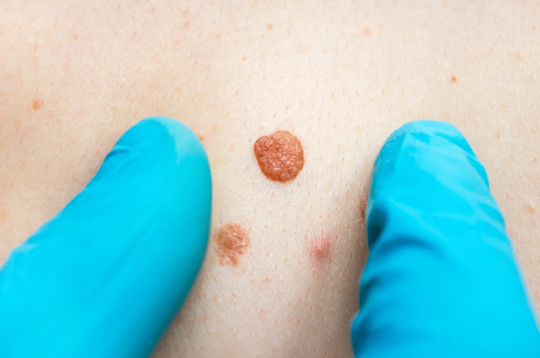 Mole removal Southampton