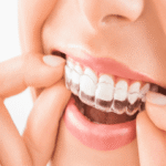 invisible braces Sydney