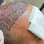 hair transplant procedure