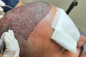 hair transplant procedure