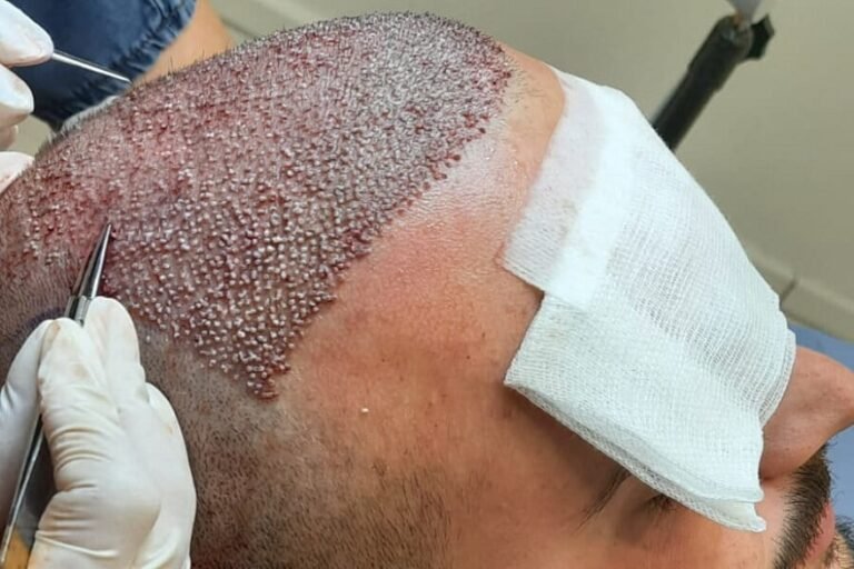 hair transplant procedure