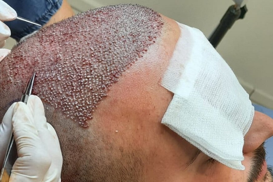 hair transplant procedure